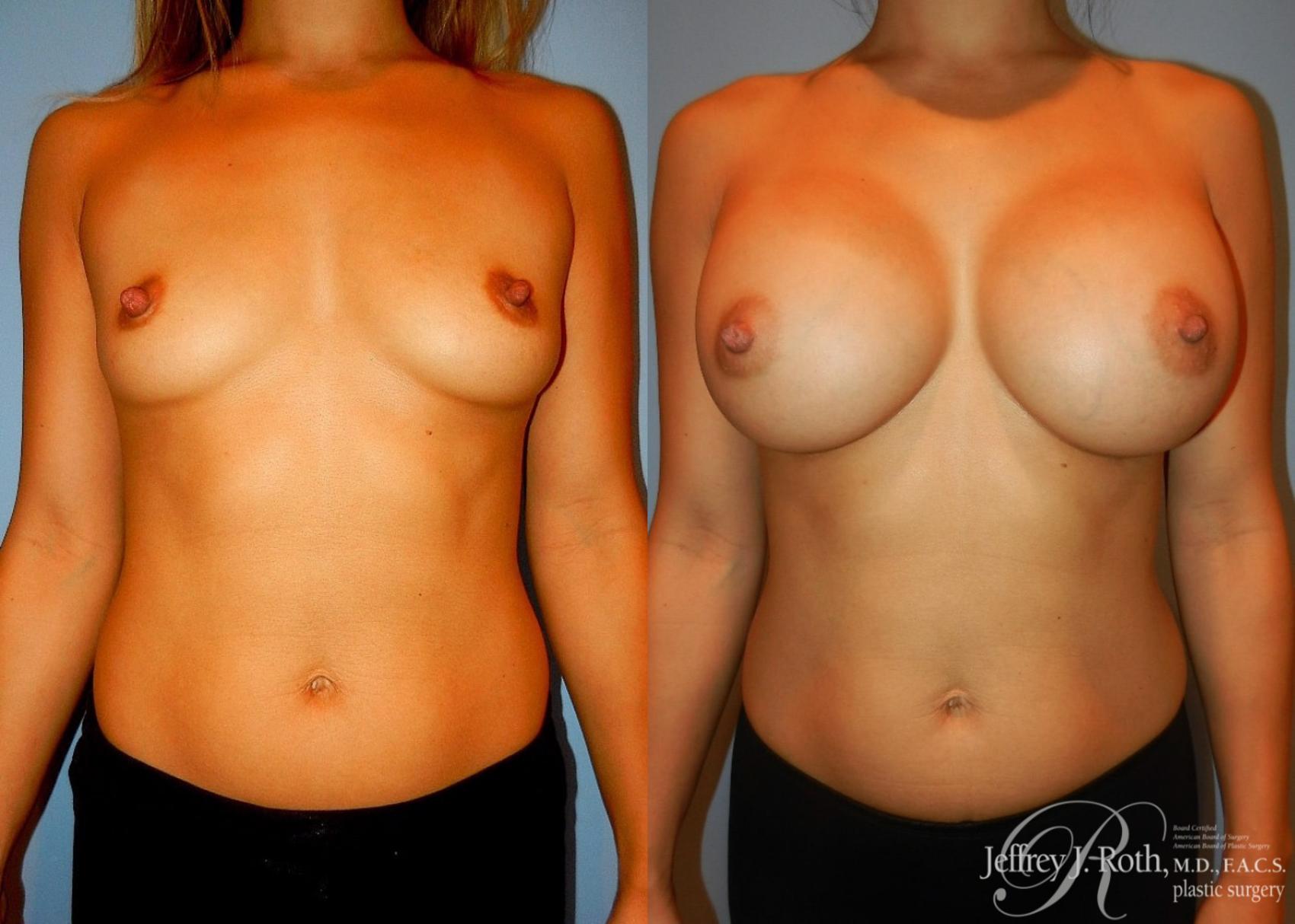 Before & After Large Breast Augmentation Case 96 View #1 View in Las Vegas, NV