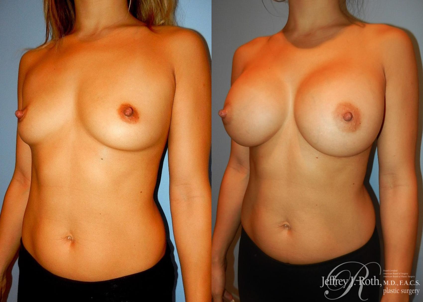 Before & After Large Breast Augmentation Case 96 View #2 View in Las Vegas, NV