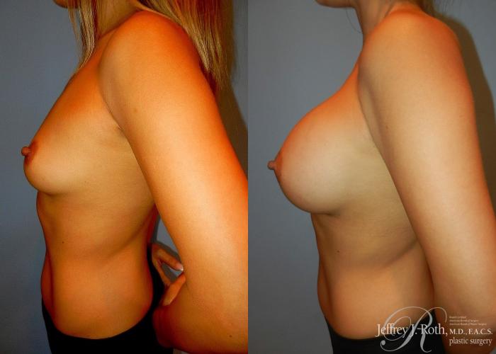 Before & After Large Breast Augmentation Case 96 View #3 View in Las Vegas and Henderson, NV
