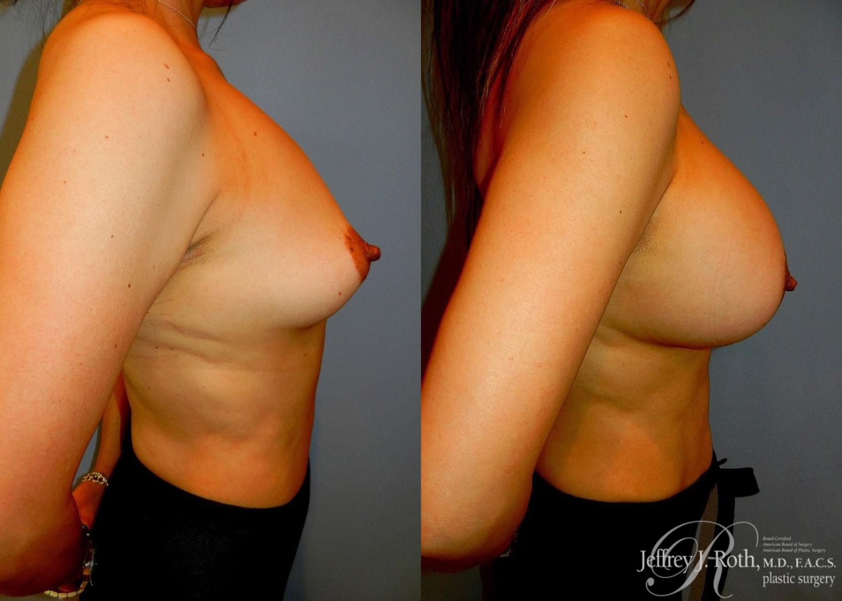 Before & After Large Breast Augmentation Case 97 View #3 View in Las Vegas, NV