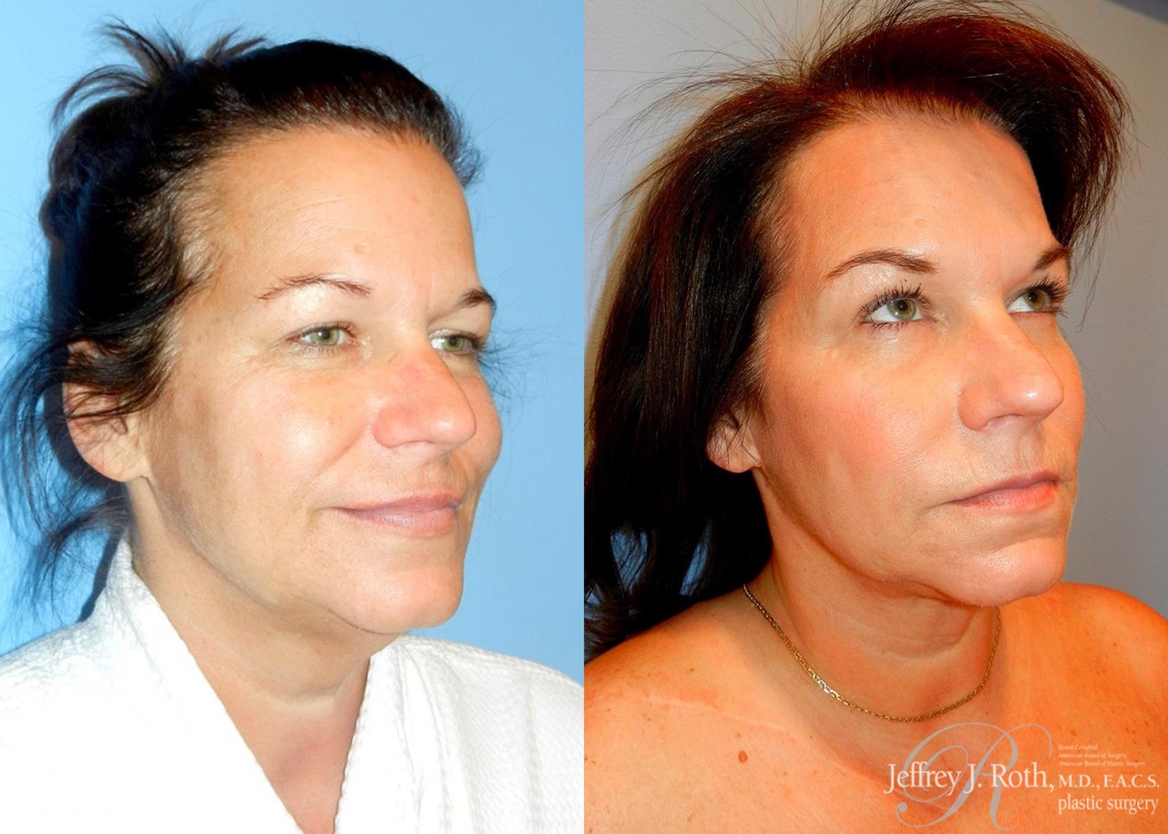 Liposuction Before and After Pictures Case 10 Las Vegas, NV Las Vegas Plastic Surgery