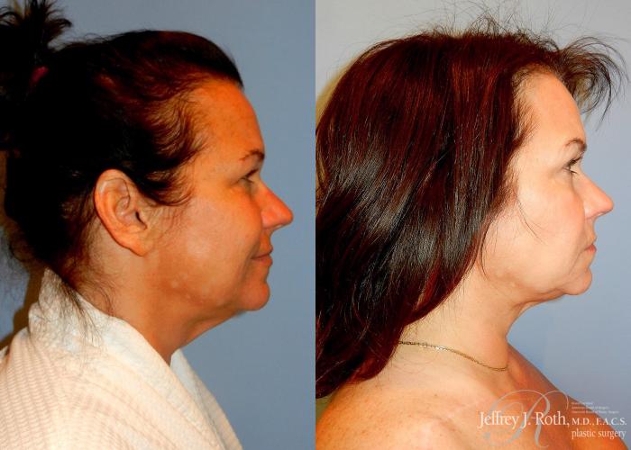 Before & After Liposuction Case 10 View #3 View in Las Vegas, NV