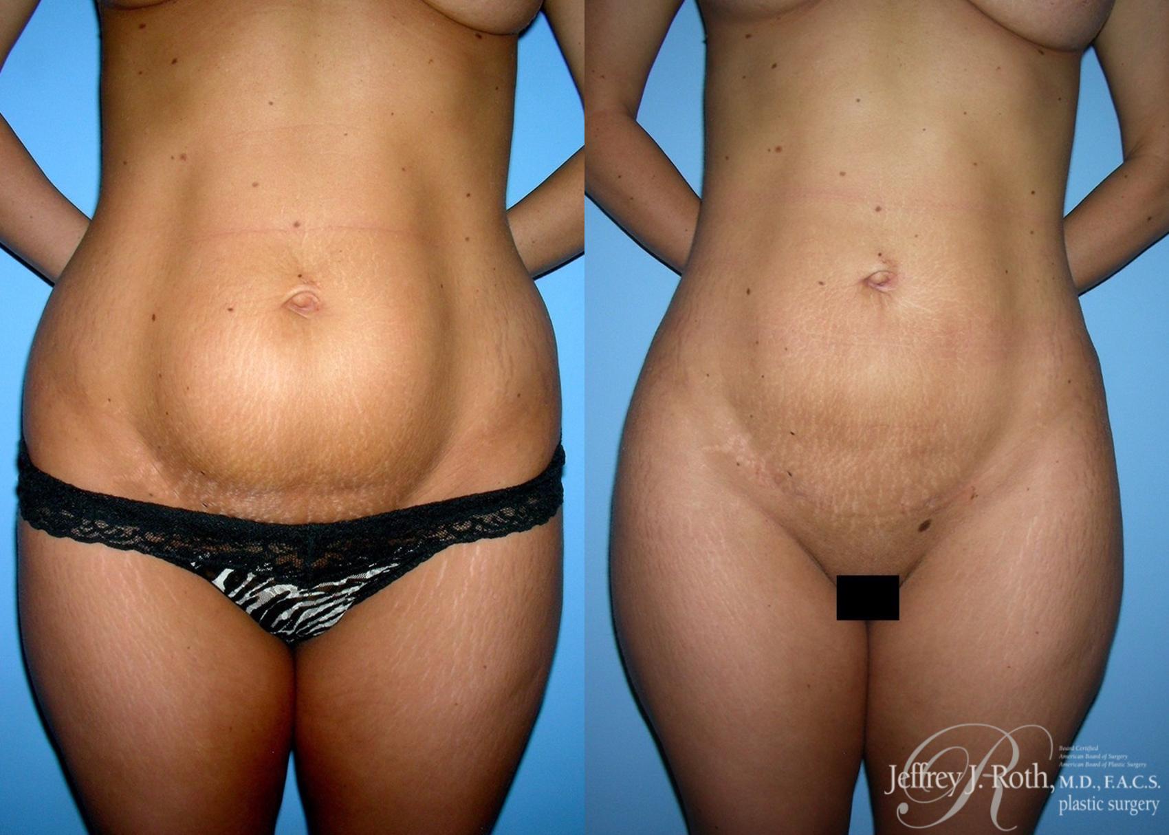 Before & After Liposuction Case 12 View #1 View in Las Vegas, NV