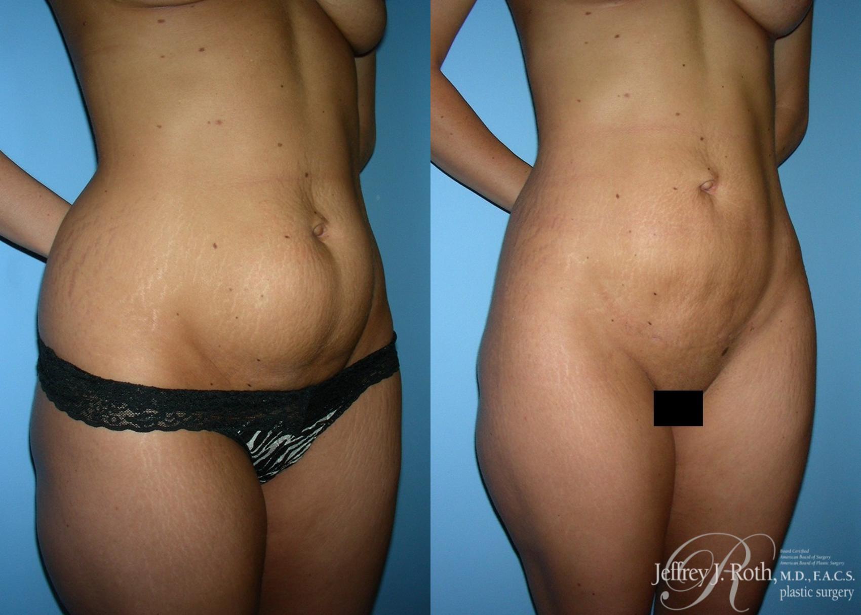 Before & After Liposuction Case 12 View #2 View in Las Vegas, NV