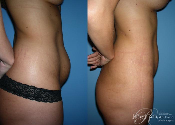 Before & After Liposuction Case 12 View #3 View in Las Vegas, NV