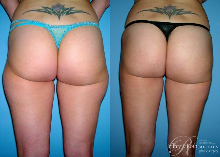 Before & After Liposuction Case 13 View #2 View in Las Vegas, NV