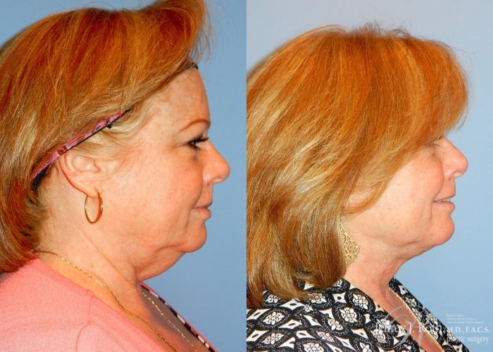 Before & After Liposuction Case 14 View #3 View in Las Vegas, NV