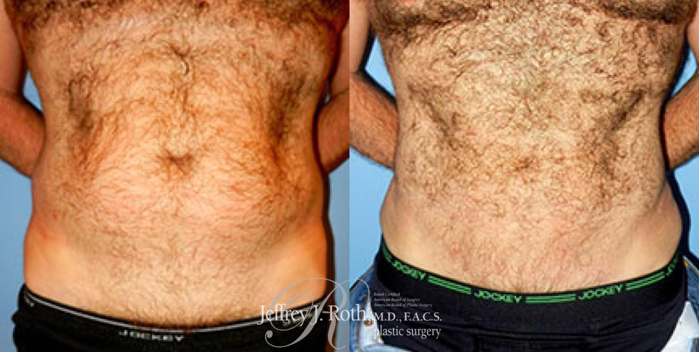 Before & After Liposuction Case 175 View #1 View in Las Vegas, NV