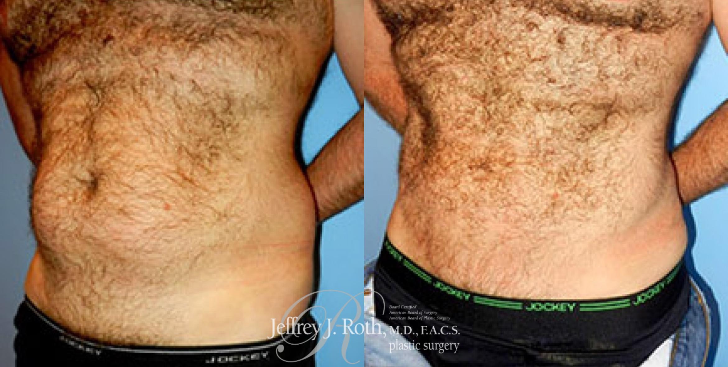 Before & After Liposuction for Men Case 175 View #2 View in Las Vegas, NV