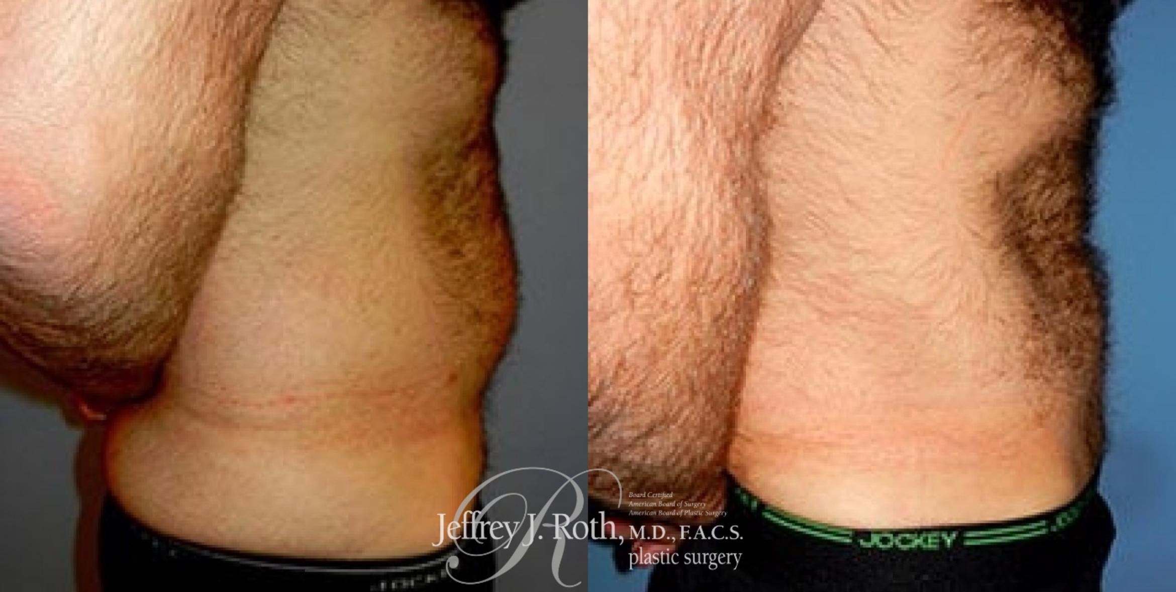 Before & After Liposuction for Men Case 175 View #3 View in Las Vegas, NV