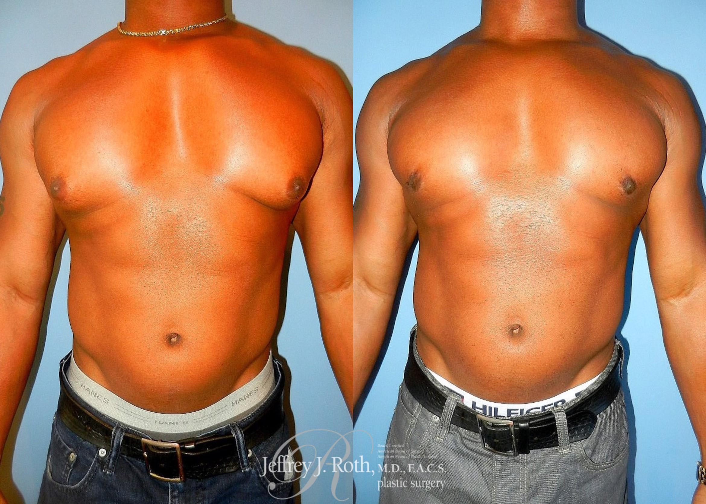 Before & After Liposuction for Men Case 176 View #1 View in Las Vegas, NV