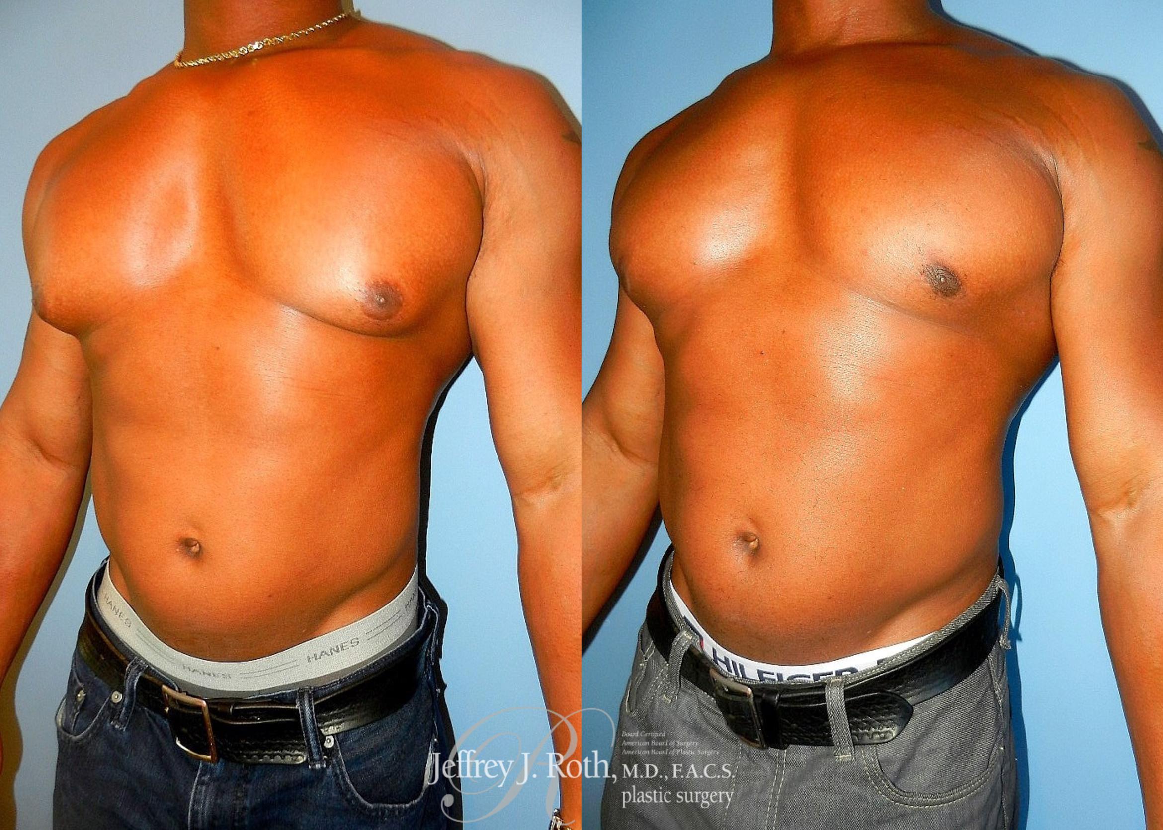 Before & After Liposuction for Men Case 176 View #2 View in Las Vegas, NV