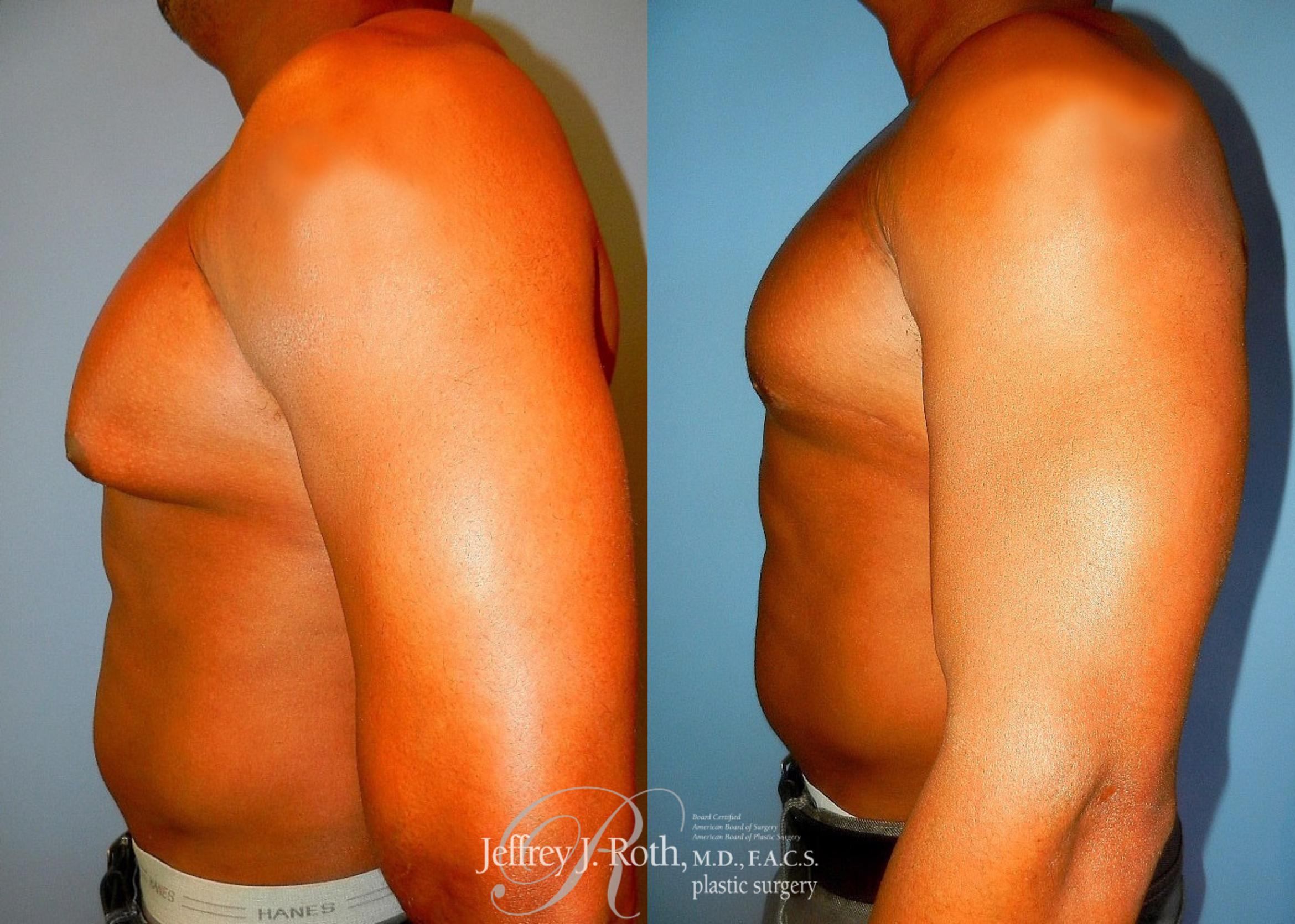 Before & After Liposuction for Men Case 176 View #3 View in Las Vegas, NV