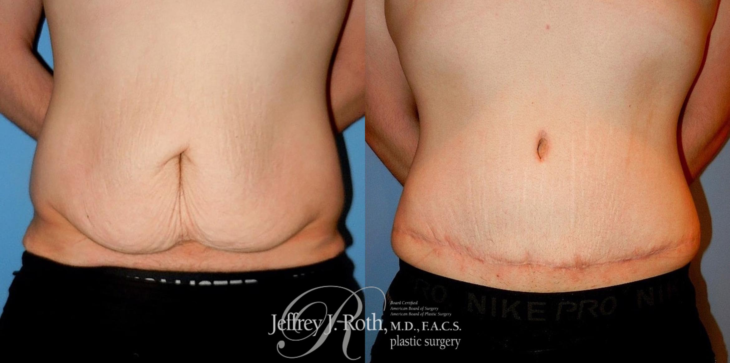 Before & After Liposuction for Men Case 177 View #1 View in Las Vegas, NV