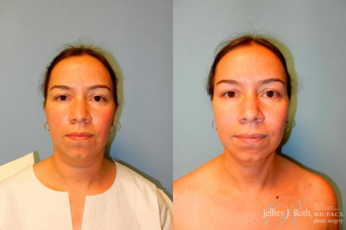 Before & After Liposuction Case 226 Front View in Las Vegas, NV