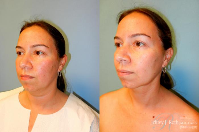 Before & After Liposuction Case 226 Left Oblique View in Las Vegas and Henderson, NV