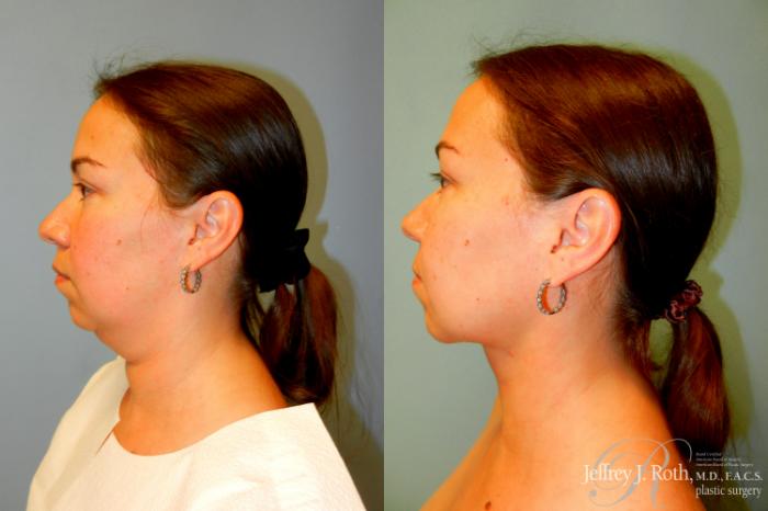 Before & After Liposuction Case 226 Left Side View in Las Vegas and Henderson, NV