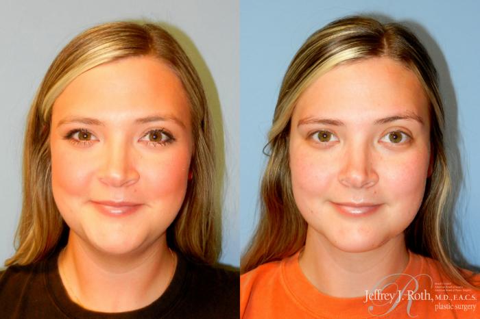 Before & After Liposuction Case 250 Front View in Las Vegas and Henderson, NV