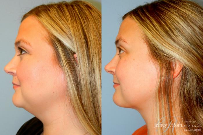 Before & After Liposuction Case 250 Left Side View in Las Vegas and Henderson, NV