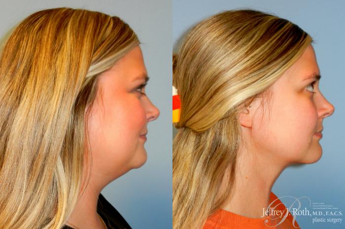 Before & After Liposuction Case 250 Right Side View in Las Vegas and Henderson, NV