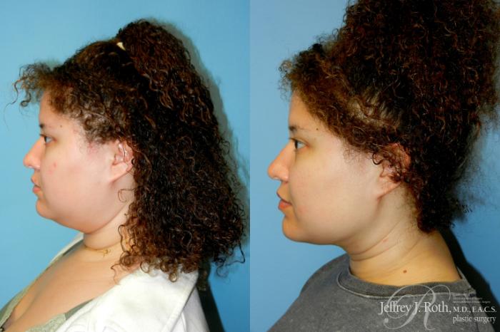 Before & After Liposuction Case 315 Left Side View in Las Vegas and Henderson, NV