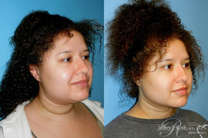 Before & After Liposuction Case 315 Right Oblique View in Las Vegas and Henderson, NV