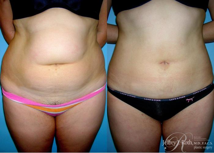 Before & After Liposuction Case 6 View #1 View in Las Vegas and Henderson, NV