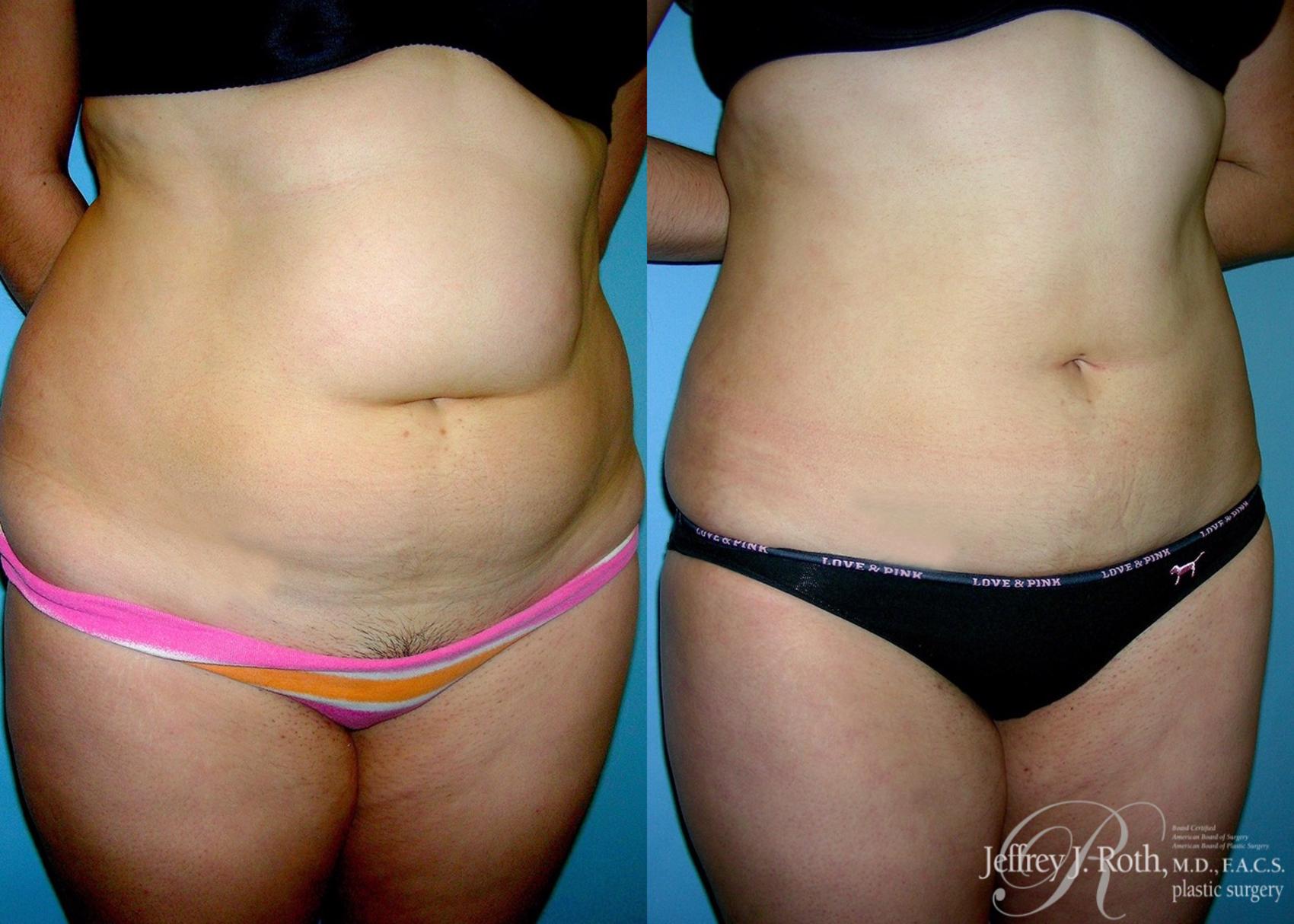 Before & After Liposuction Case 6 View #2 View in Las Vegas, NV