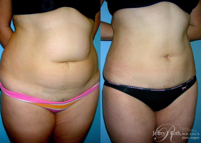 Before & After Liposuction Case 6 View #2 View in Las Vegas and Henderson, NV