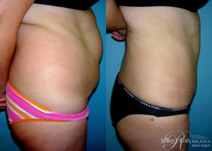 Before & After Liposuction Case 6 View #3 View in Las Vegas and Henderson, NV