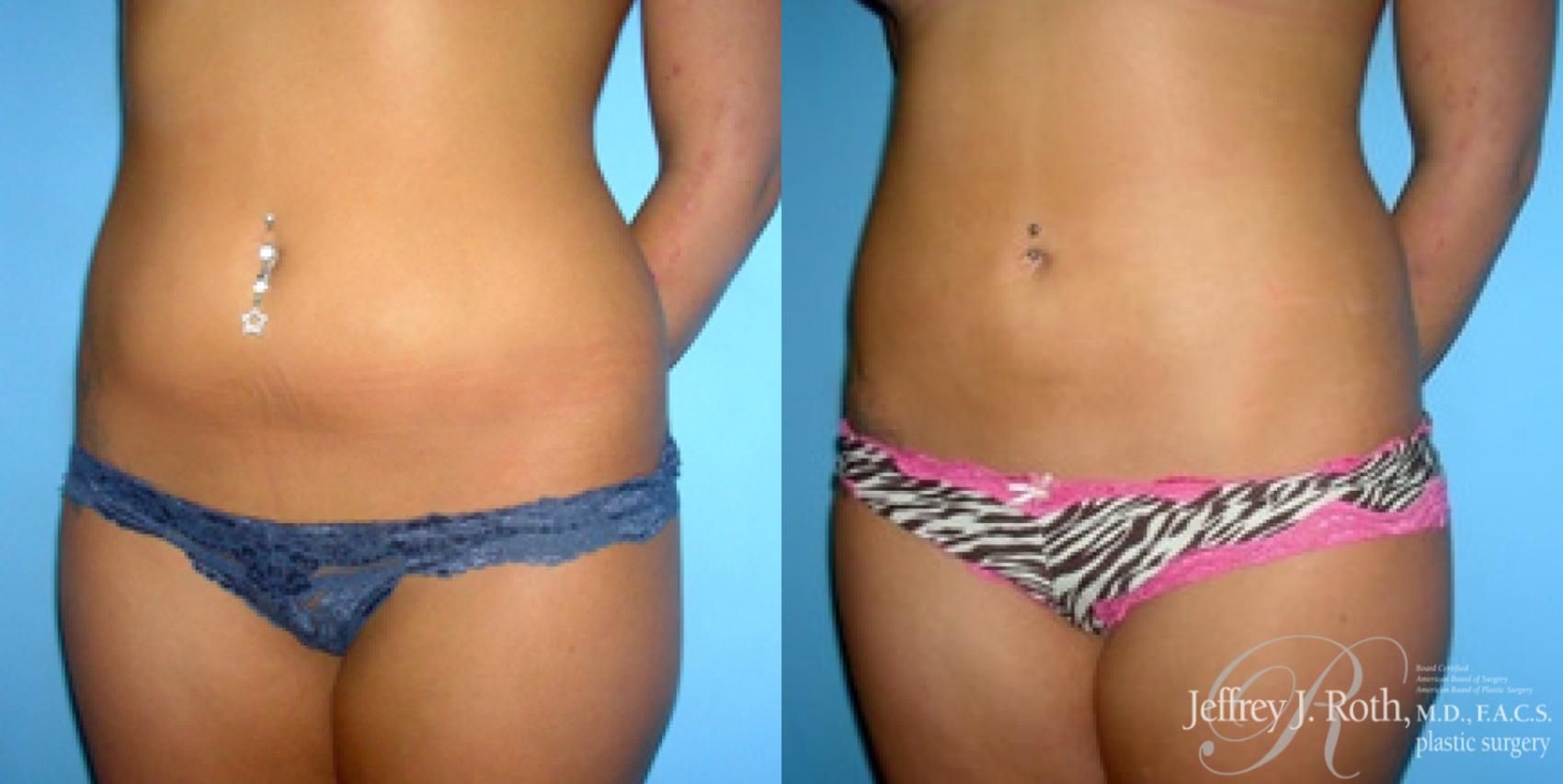 Before & After Liposuction Case 7 View #2 View in Las Vegas, NV