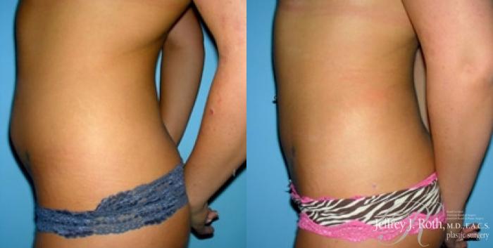 Before & After Liposuction Case 7 View #3 View in Las Vegas and Henderson, NV