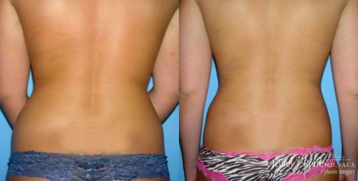 Before & After Liposuction Case 7 View #4 View in Las Vegas and Henderson, NV