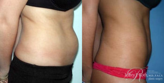 Before & After Liposuction Case 8 View #2 View in Las Vegas and Henderson, NV