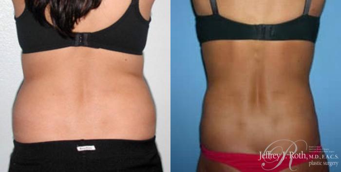 Before & After Liposuction Case 8 View #3 View in Las Vegas and Henderson, NV