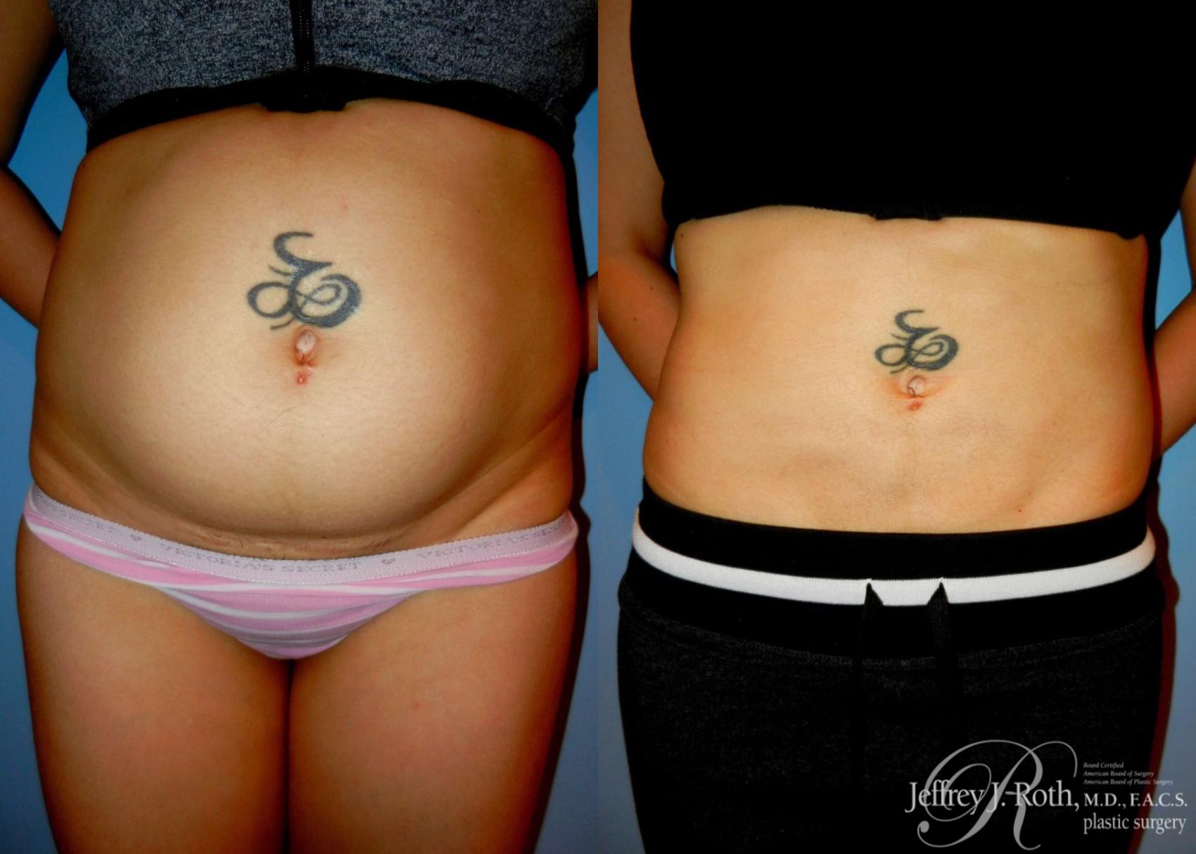 Before & After Liposuction Case 9 View #1 View in Las Vegas, NV