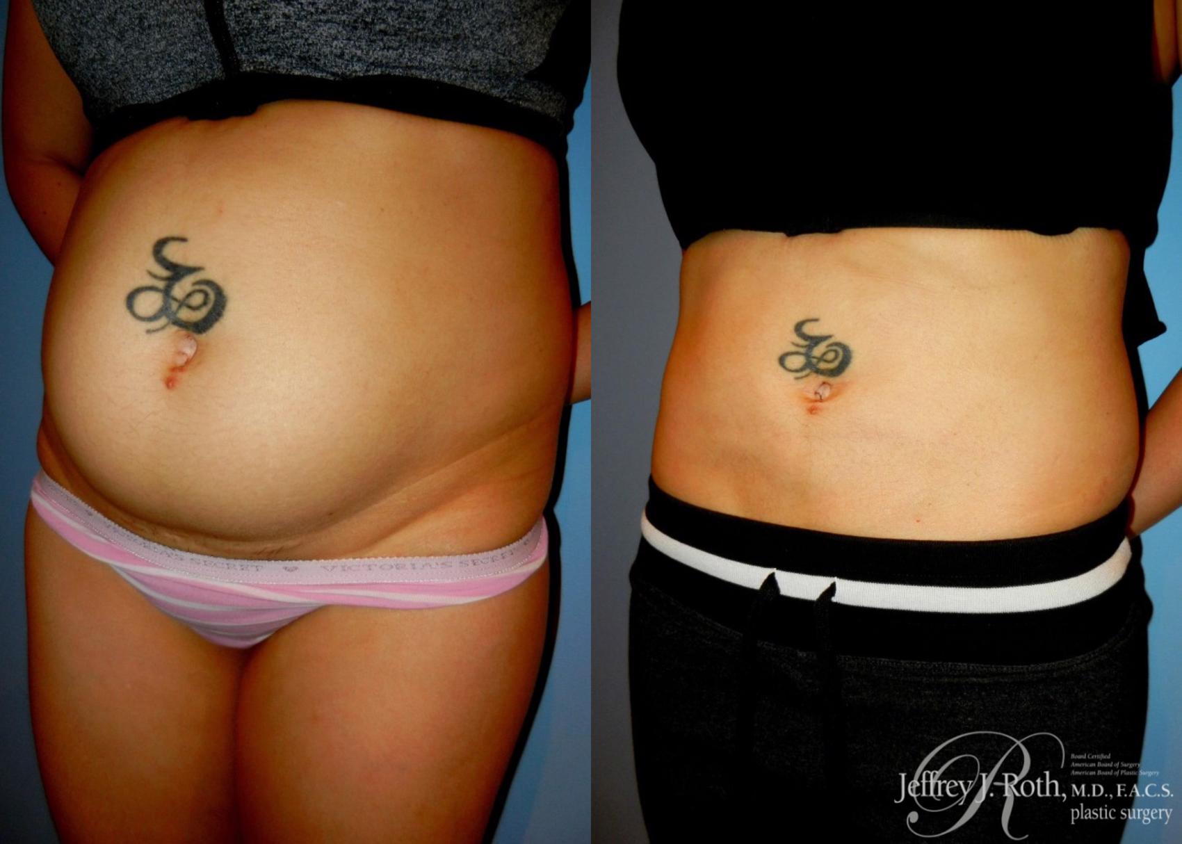Before & After Liposuction Case 9 View #2 View in Las Vegas, NV