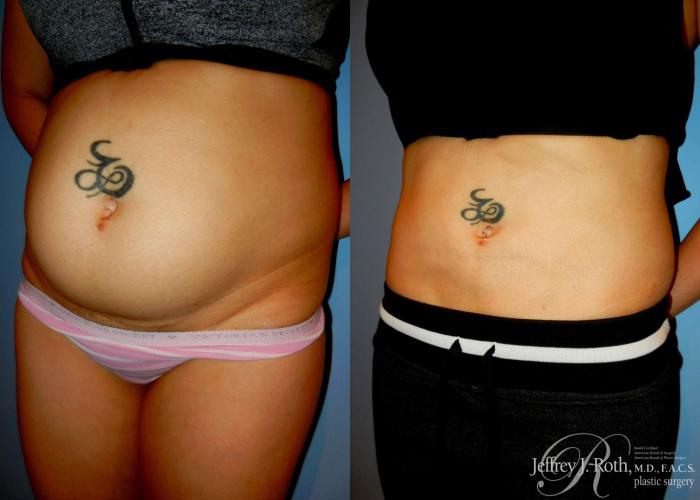 Before & After Liposuction Case 9 View #2 View in Las Vegas and Henderson, NV
