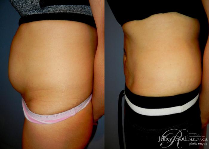 Before & After Liposuction Case 9 View #3 View in Las Vegas and Henderson, NV