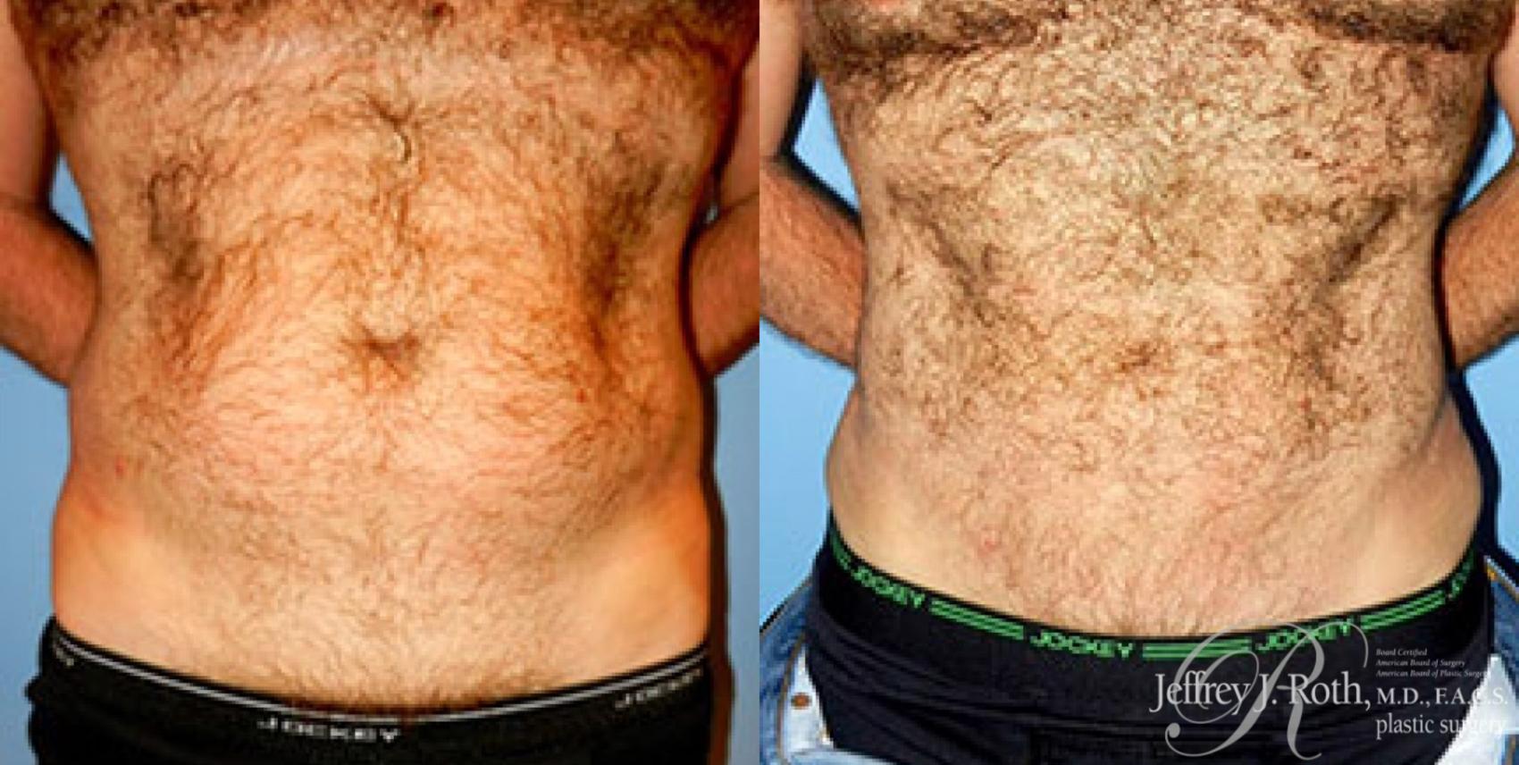 Before & After Liposuction for Men Case 175 View #1 View in Las Vegas, NV