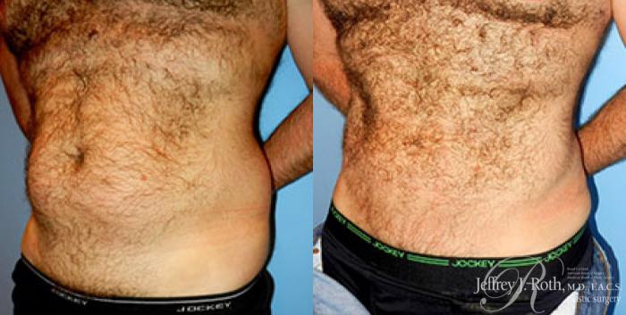Before & After Liposuction for Men Case 175 View #2 View in Las Vegas, NV