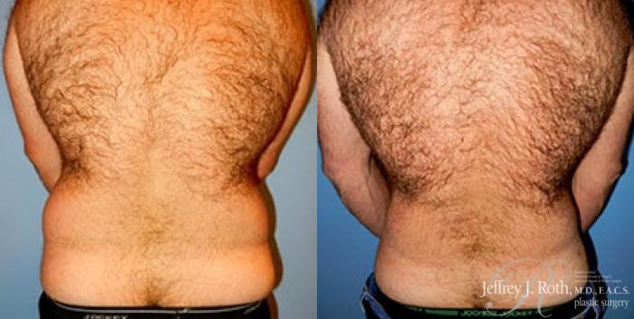 Before & After Liposuction for Men Case 175 View #4 View in Las Vegas, NV
