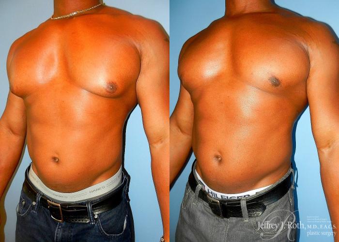 Before & After Liposuction for Men Case 176 View #2 View in Las Vegas, NV
