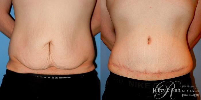 Before & After Liposuction for Men Case 177 View #1 View in Las Vegas and Henderson, NV
