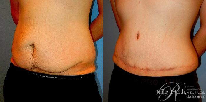 Before & After Liposuction for Men Case 177 View #2 View in Las Vegas and Henderson, NV