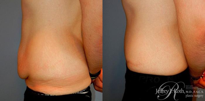 Before & After Liposuction for Men Case 177 View #3 View in Las Vegas and Henderson, NV