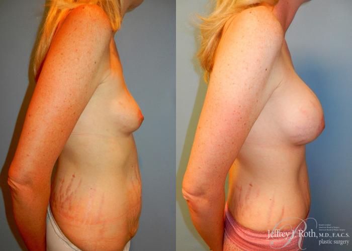 Before & After Mommy Makeover Case 20 View #3 View in Las Vegas, NV