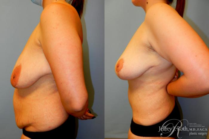 Before & After Mommy Makeover Case 235 Left Side View in Las Vegas and Henderson, NV