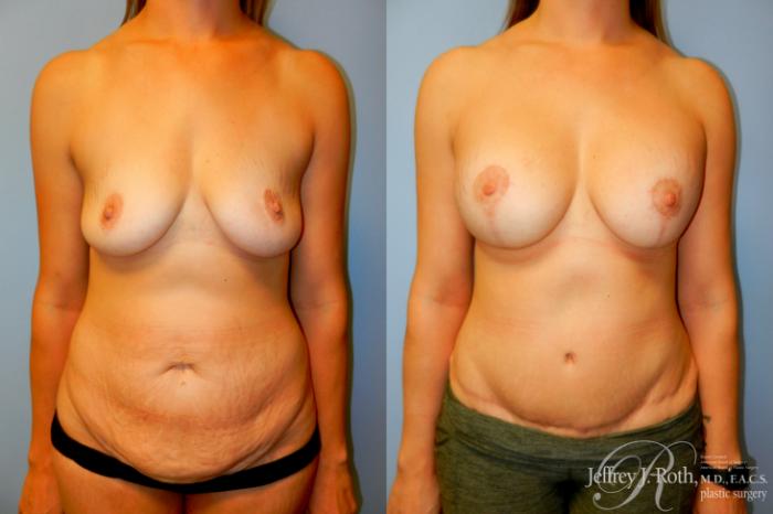 Before & After Liposuction Case 259 Front View in Las Vegas, NV