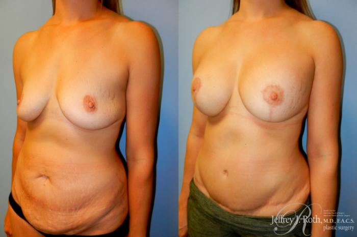 Before & After Tummy Tuck Case 259 Left Oblique View in Las Vegas and Henderson, NV